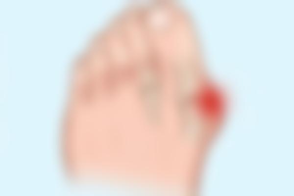 苏敬达做大脚骨手术好不好?苏医生做这个手术挺靠谱,成效也很不错