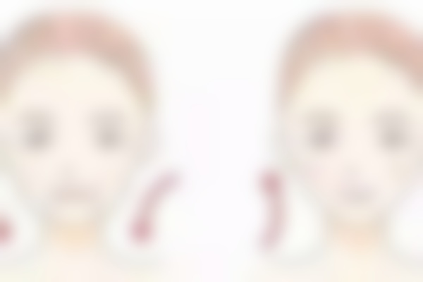 北京黄寺李晓东(深层提升)VS 杜太超(微创微调)怎么选才对?深层提升抗衰,微创微调做小调整