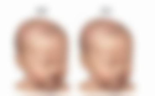 深圳鹏程医疗美容医院除皱针价格范围