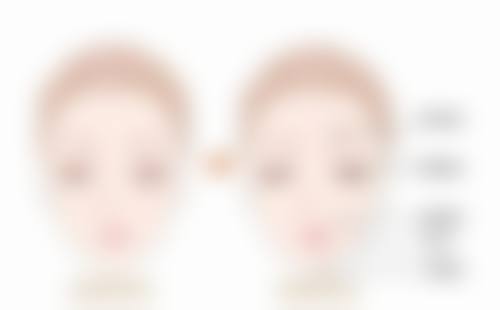 上海愉悦薇莱医疗美容医院陈红梅医生眼部修复技术特色