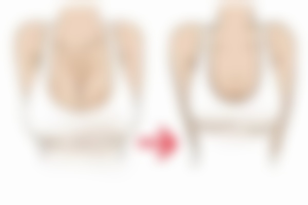 深圳富华整形医院唐新辉隆胸怎么样?他做隆胸挺靠谱的，特别多人觉得成效自然