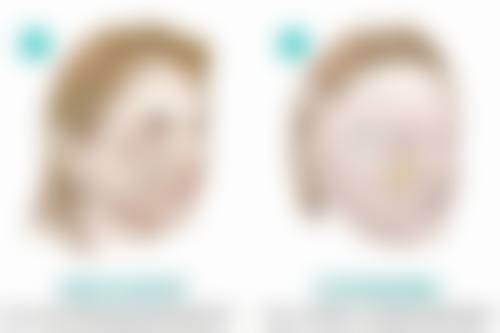 {馒化针打3天效果图片，实测消50%发泡感，4000 - 6000元起重塑精致轮廓！ 