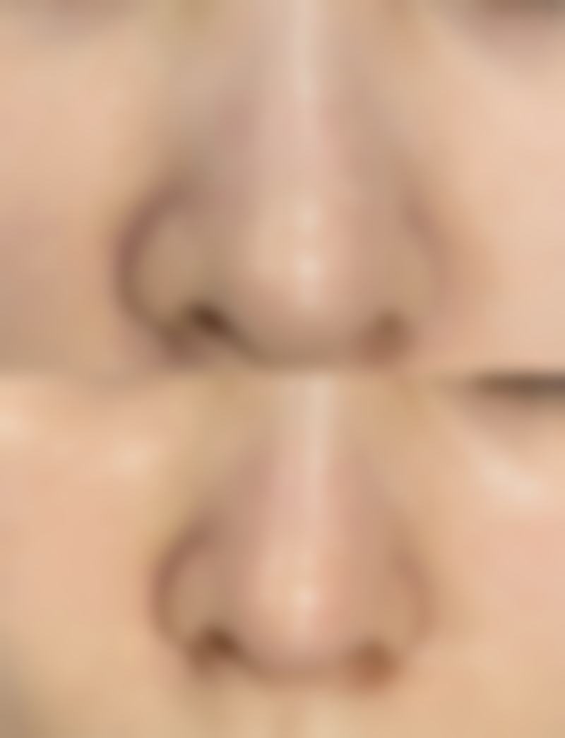 成都素美刘远程拉皮体验之旅，从脸垮到紧致逆袭，术后效果惊艳似换脸！ 