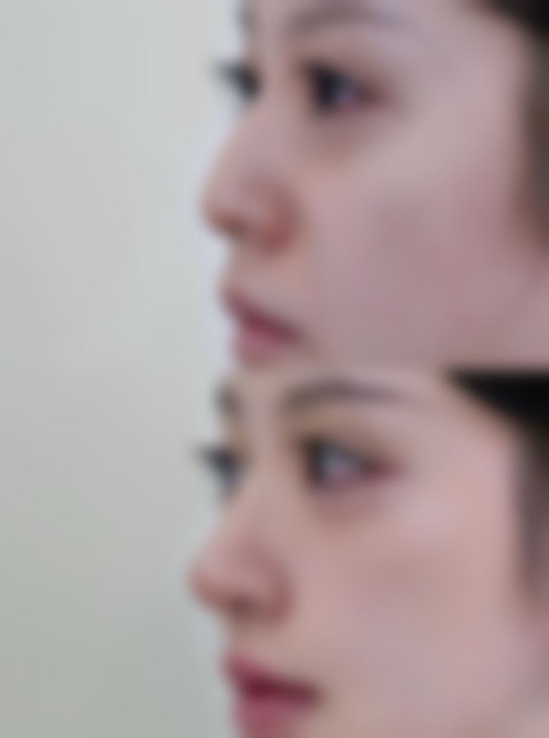 馒化针打3天后续成效值得期待