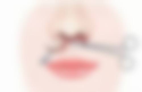 深圳福雅医疗做人中缩短的术前术后要注意什么？