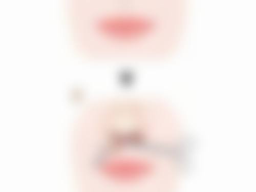 深圳福雅医疗做人中缩短的价格和性价比如何？