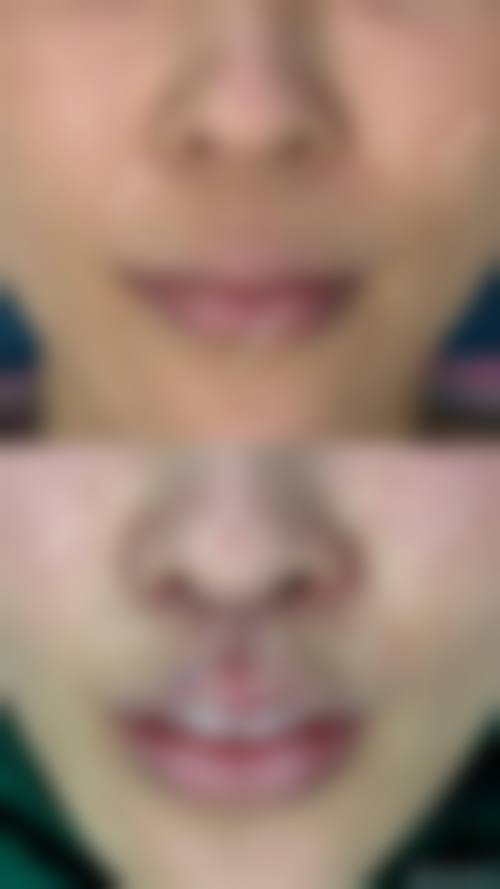 深圳福雅医疗做人中缩短适合哪些人群？