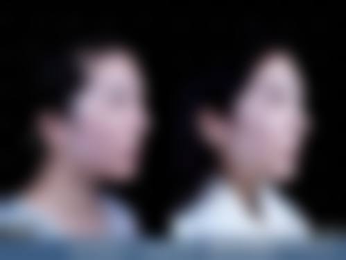 骨粉取出哪里取得干净？可选广州军美、北京丽星翼美等有专项取除技术的机构