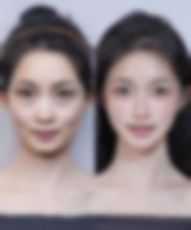 四、上海虹桥医院拇外翻手术的实际实例