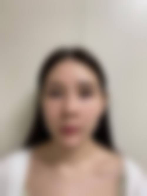 巫文云膨体隆鼻价位详情