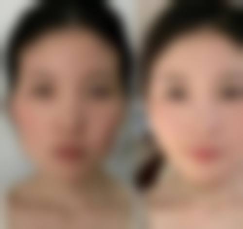 选择刘丽琴医生打玻尿酸的建议