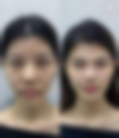 三、用玻尿酸垫下巴后悔了的解决办法