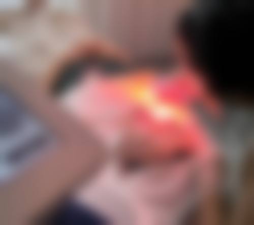 广州红十字会医院皮秒激光祛斑价格揭秘