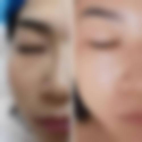 广州红十字会医院光子祛斑价格揭秘