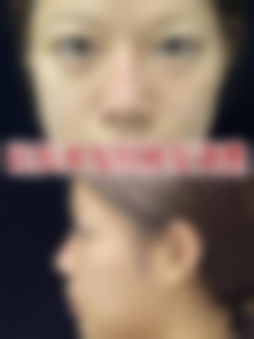 深圳哪家做鼻子最专业？李信锋张辉领衔，主打自然鼻型与鼻修复技术