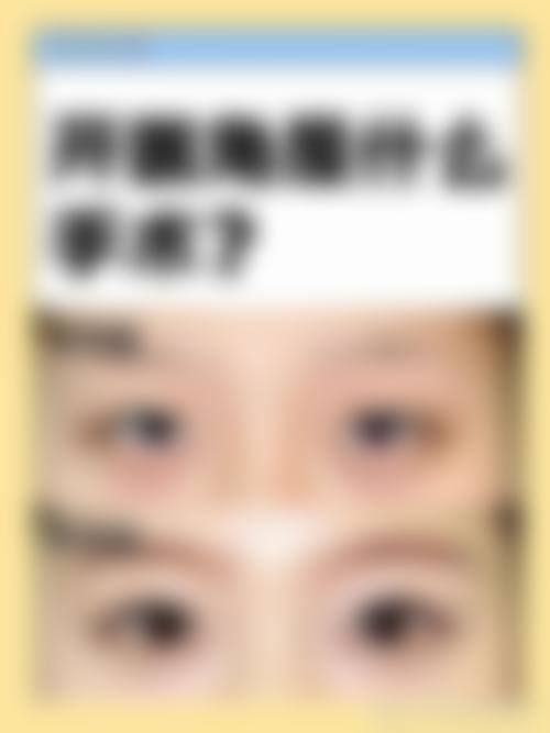 成都米兰柏羽开眼角手术价格