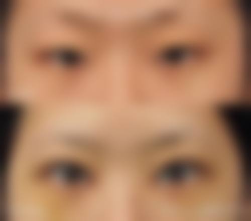 成都米兰柏羽基础双眼皮术式价格