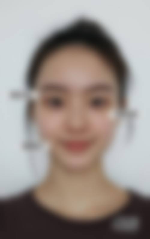 成都米兰柏羽卢尚兵医生眼部手术价格