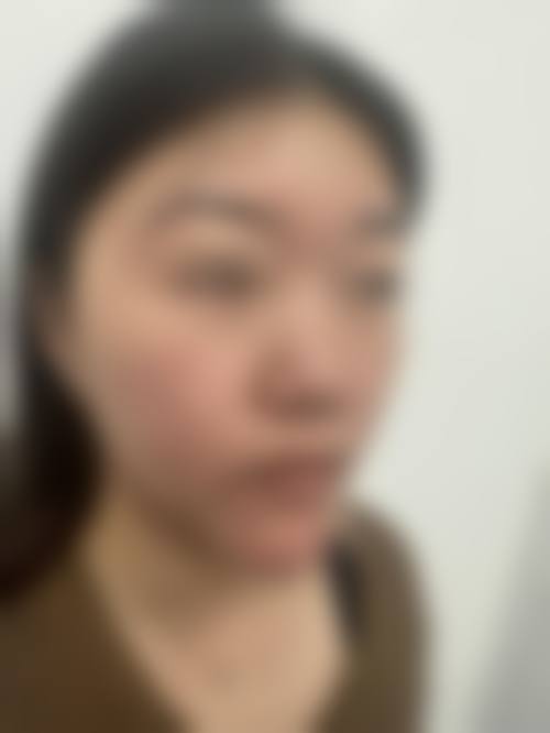 王阔远不动骨面部减容技术亮点