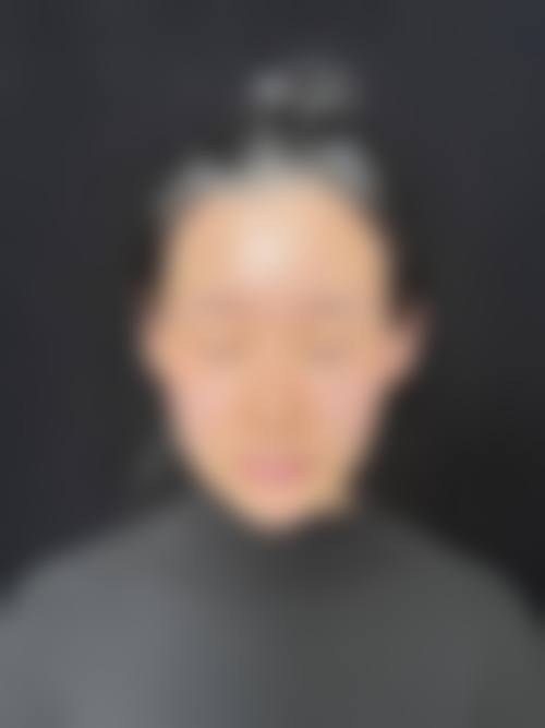 王阔远案例｜我找他做不动骨面部减容+眼修复，术后脸精致自然真的太惊喜