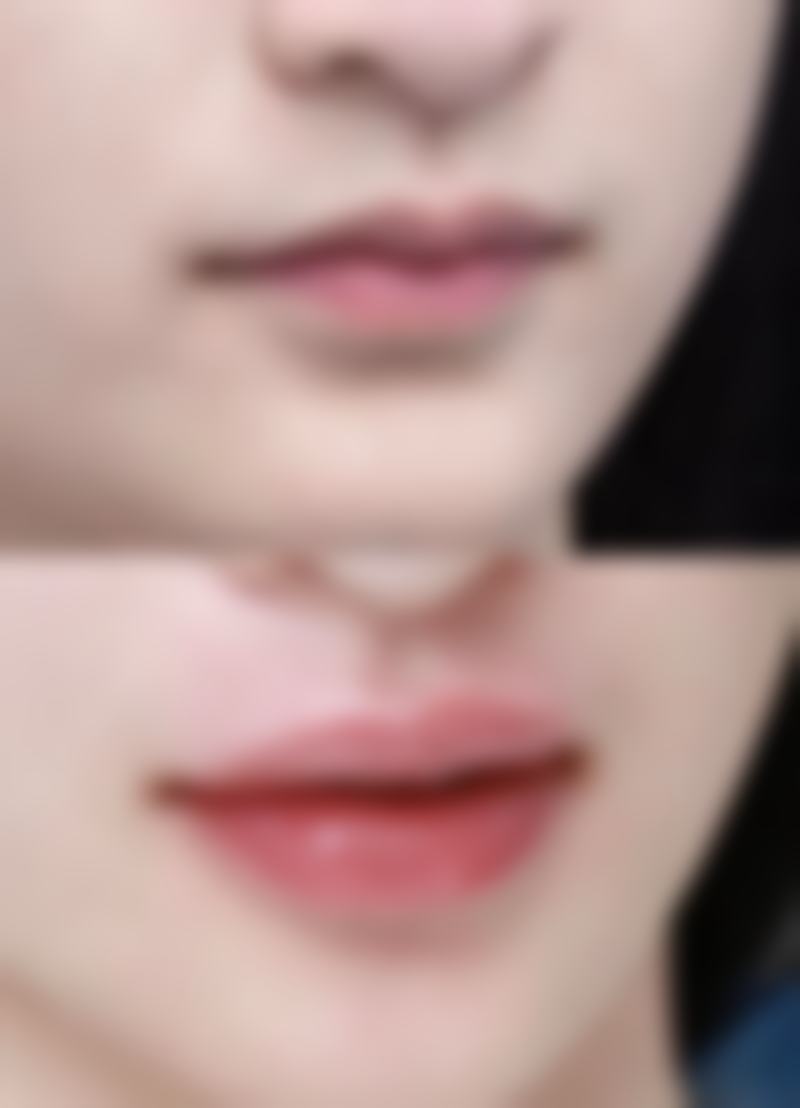 庄洪兴医生耳再造技术优势