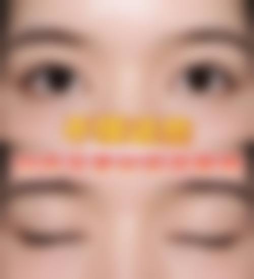 上海颜净卢玲割双眼皮多少钱