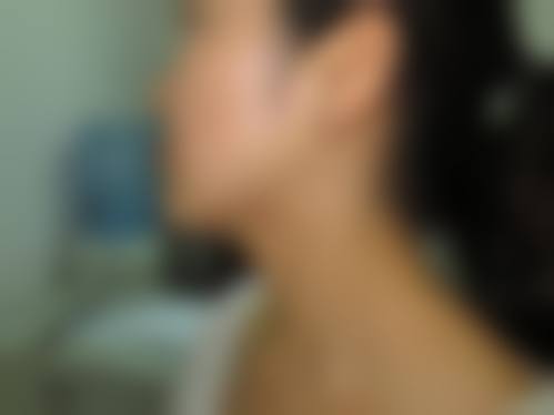 三、上海马娟双眼皮修复医院的成功实例