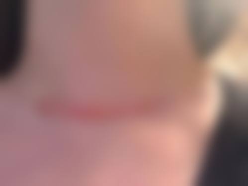 不同类型疤痕修复要花多少钱