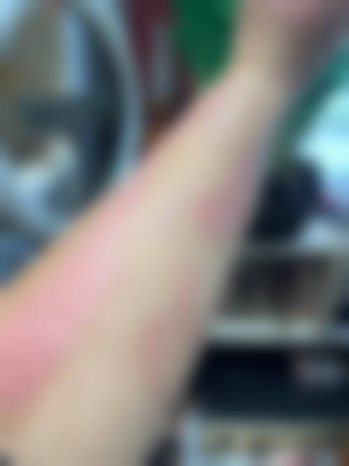 注射治疗疤痕要花多少钱