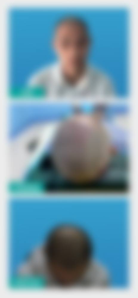 重庆大麦微针植发医院收费价格表/收费标准