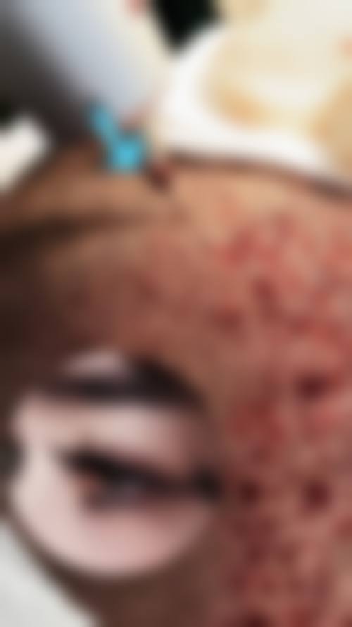 重庆大麦微针植发医院真人口碑评价怎么样？