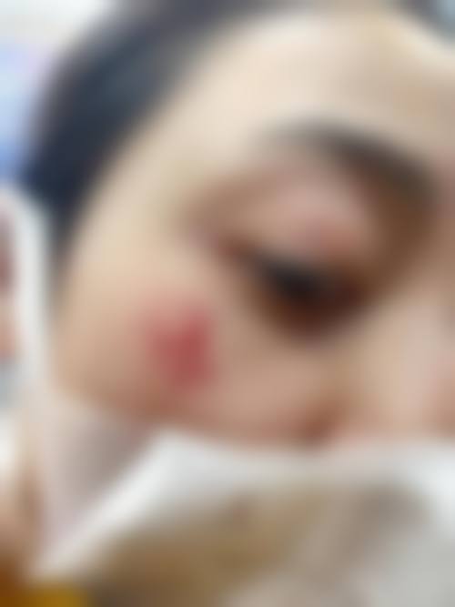 汕头附二医院E光嫩肤多少钱