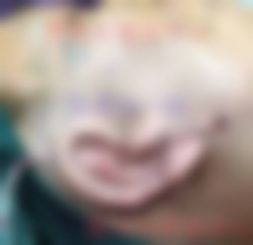 术后修复的艰辛与惊喜