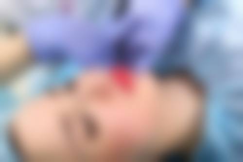 深圳胡俊杰医生可约人中缩短面诊