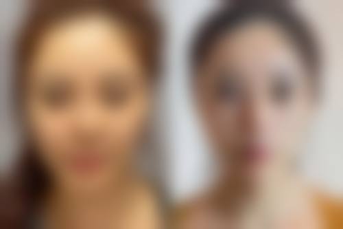 微拉美与线提升的适用人群和适应症分析