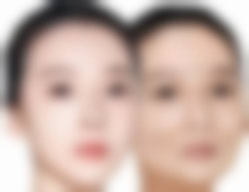 微拉美与线提升的手术过程和修复情况对比