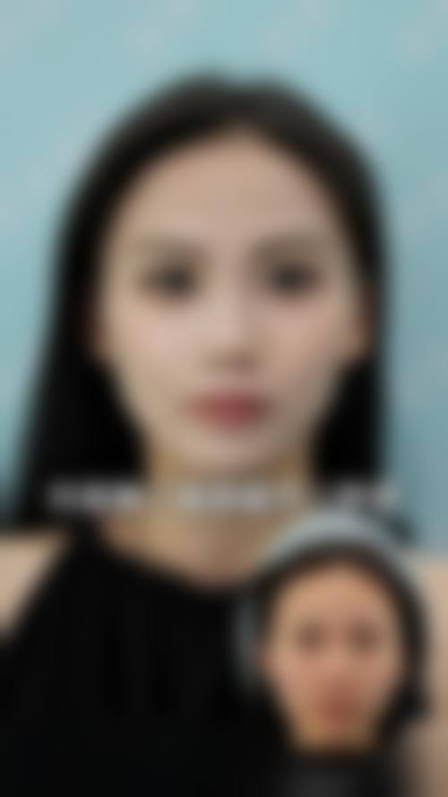 选择微拉美还是线提升的综合考量