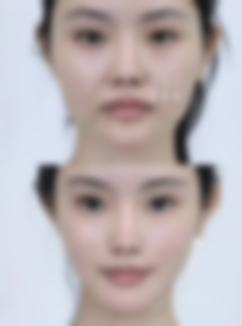 微拉美好还是线雕好? 轻中度面部松弛选线雕，中重度选微拉美更持久