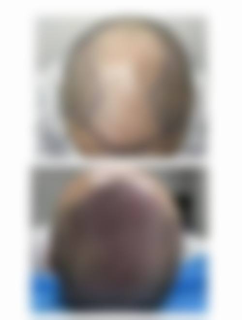 二、西安大麦微针植发是正规连锁机构吗？