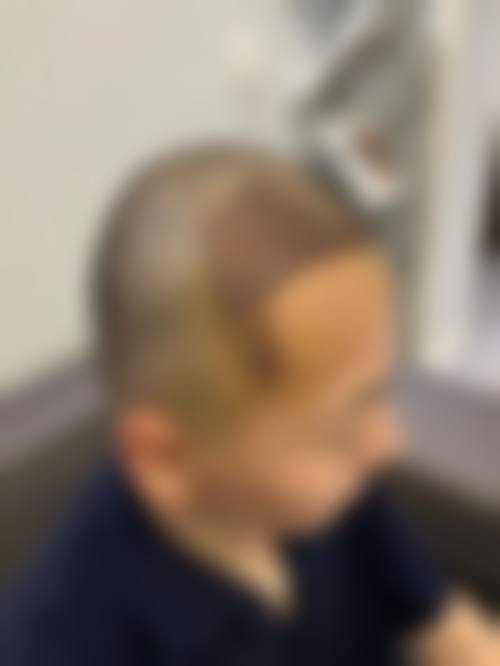 西安大麦微针植发靠谱吗？正规连锁，微针技术精细，口碑获发友认可