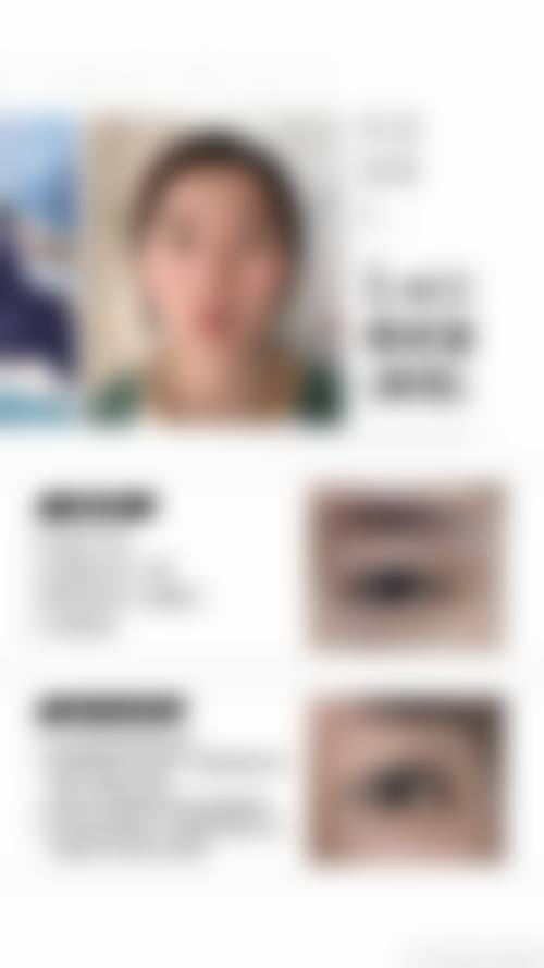 自然无痕的史迎军眼修复成果