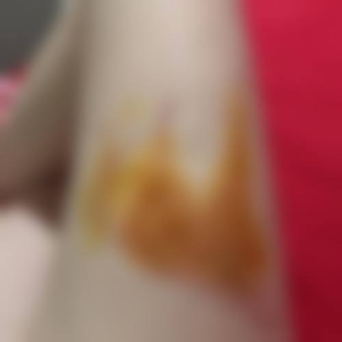 三、激光祛疤的医院推荐