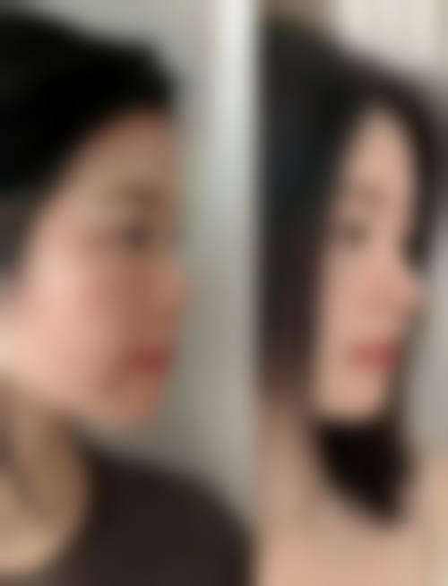 李长富隆鼻预约后面诊流程