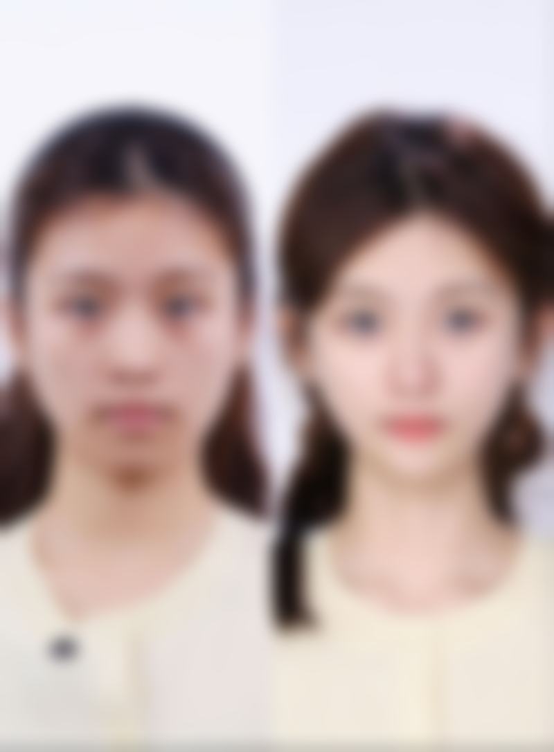 成都科妍医疗美容诊所上眼睑下垂整形技术怎么样