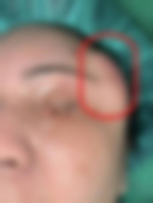 20年前做过注射隆胸变硬疼痛，多因奥美定残留引发并发症，应尽快手术取出