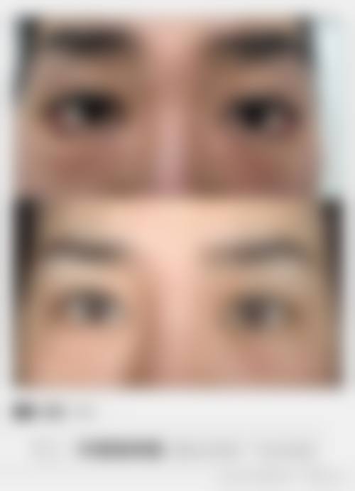 肿胀减半的神奇成效