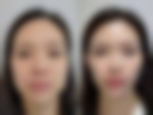 刘金超院长拉皮手术成功实例分享