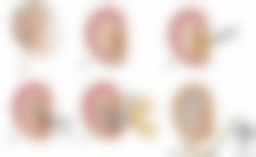 张正文天使全耳再造术