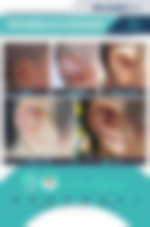 张正文直埋法耳再造