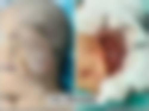 张正文耳再造多少钱？直埋法6万起全包法10万起，3D打印复刻耳型稳定率95%